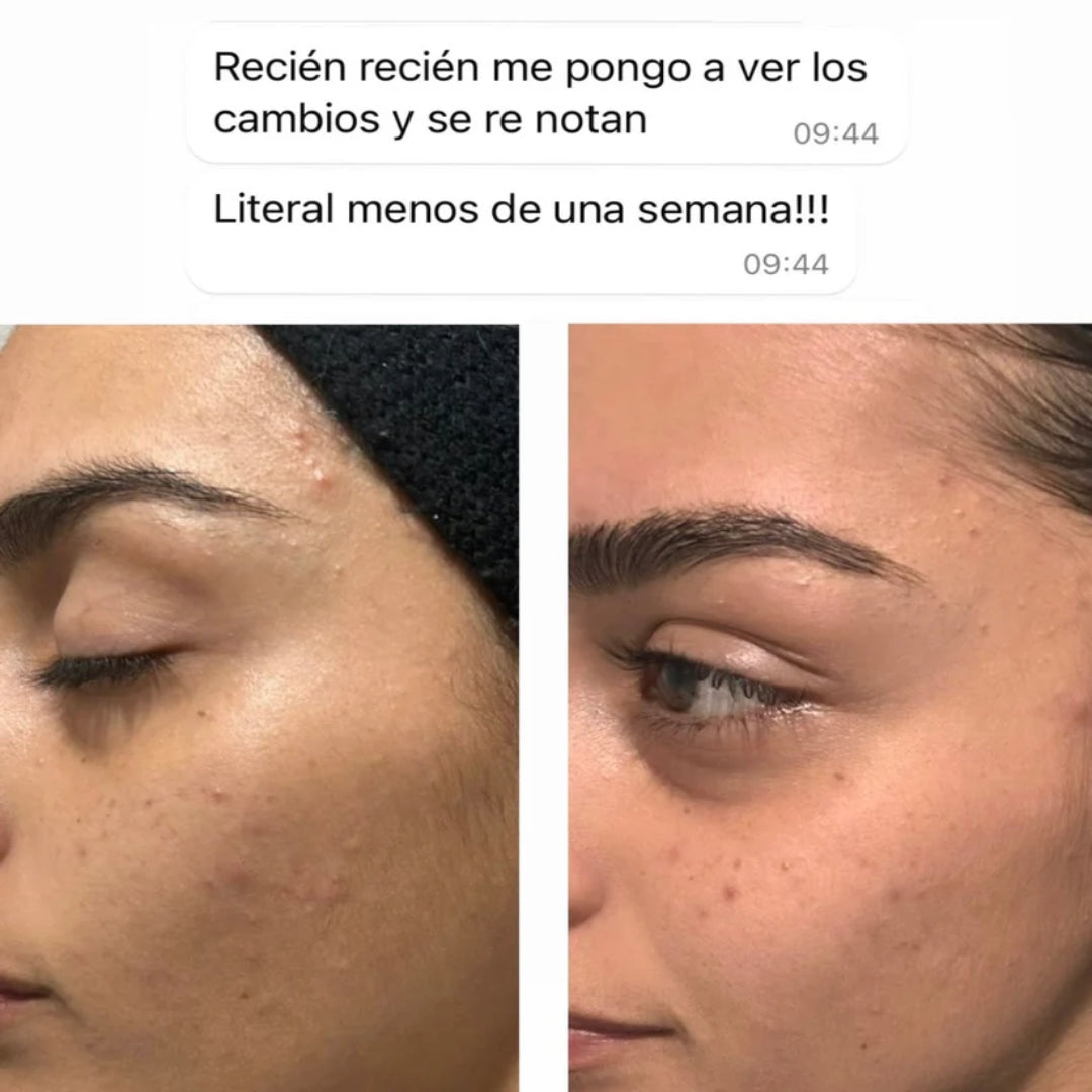 CLEARADVANCE™- Antiacné