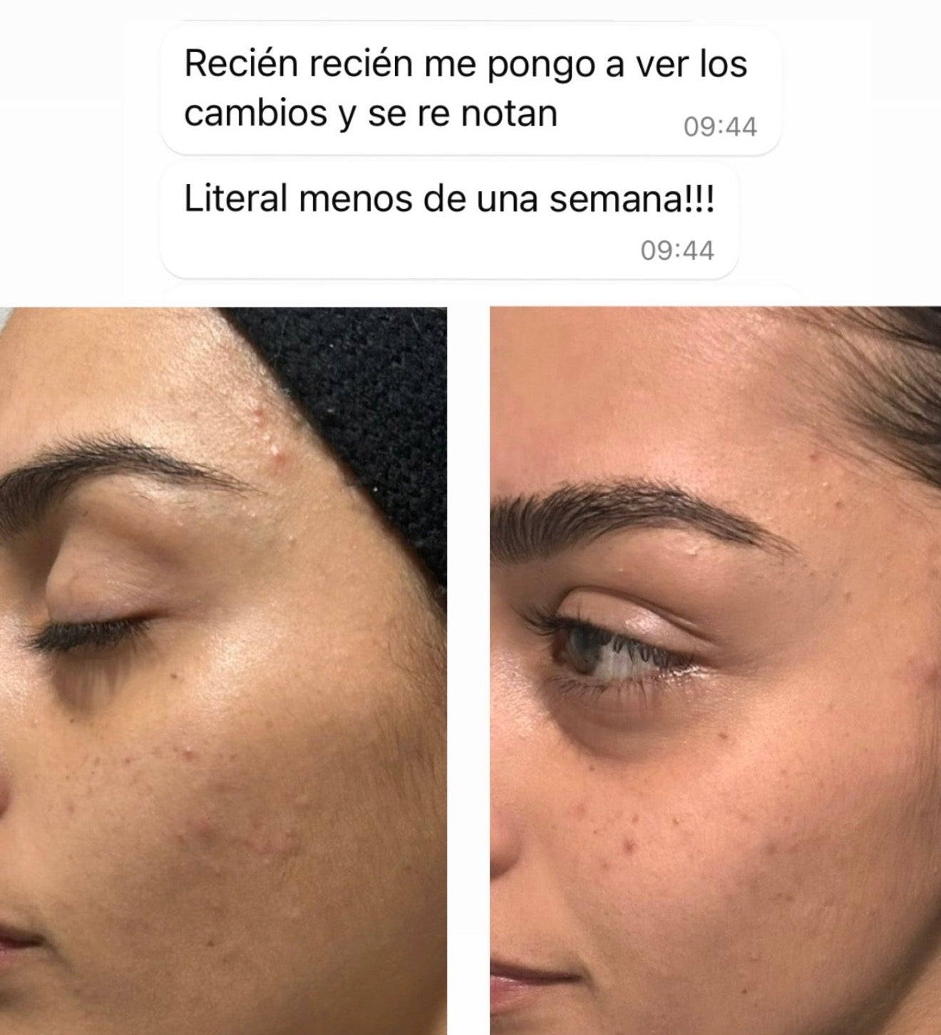 CLEARADVANCE™-Elimina el acné hormonal