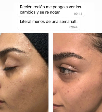 CLEARADVANCE™-Elimina el acné hormonal