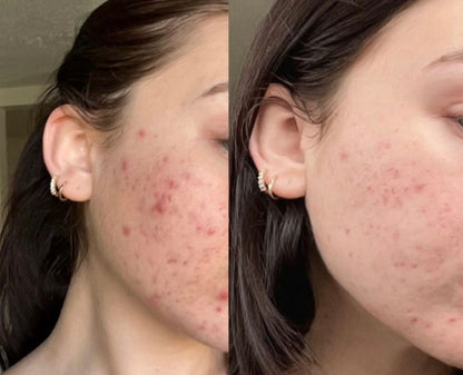 CLEARADVANCE™-Elimina el acné hormonal