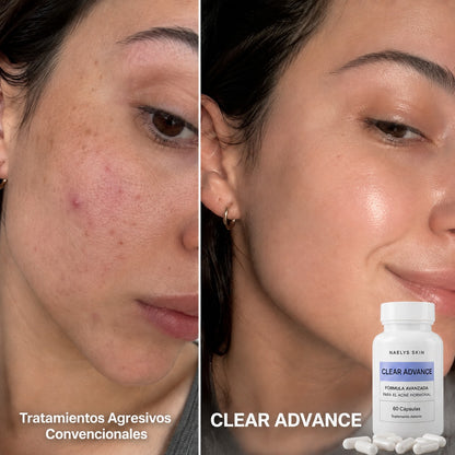 CLEARADVANCE™- Antiacné