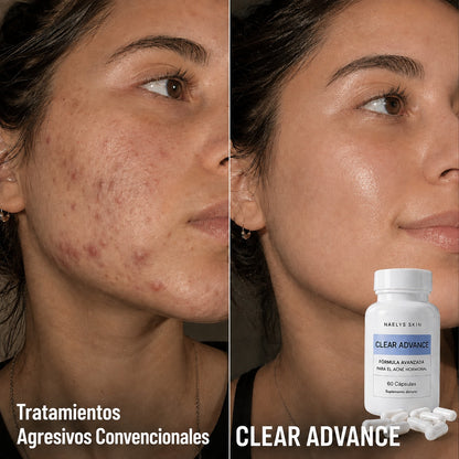 CLEARADVANCE™- Antiacné
